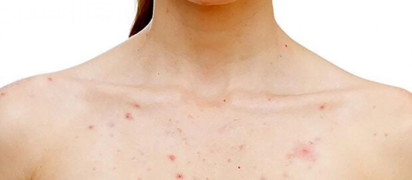 Σπυράκια ιδρώτα από ζέστη ή άσκηση: Τι να κάνεις για να φύγουν και να μην ξαναβγούν